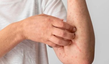 El sarampión y la política